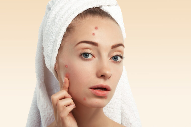 Depigmenting Peels