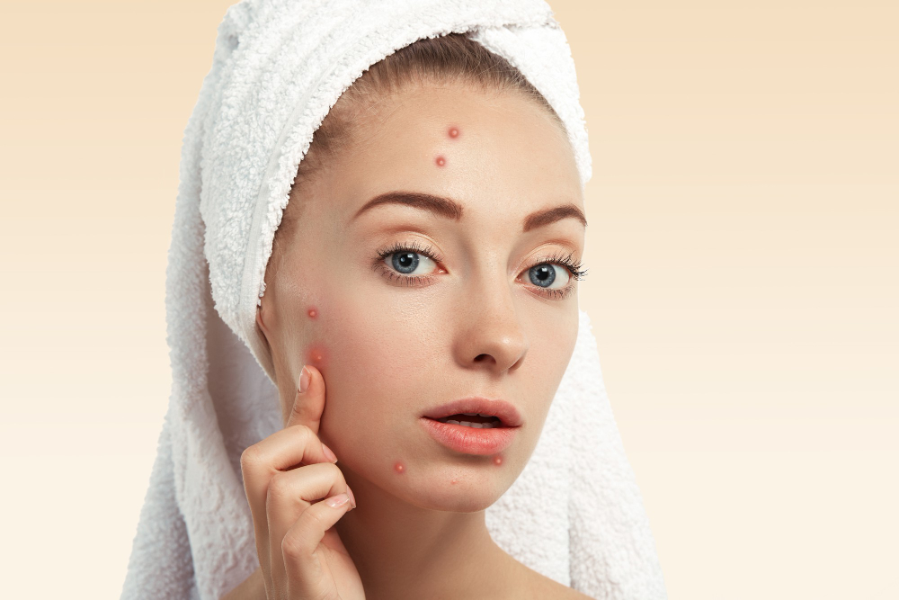 Depigmenting Peels